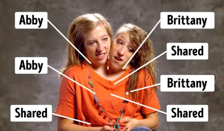 The Conjoined Twins Abby And Brittanny Frontlines Media