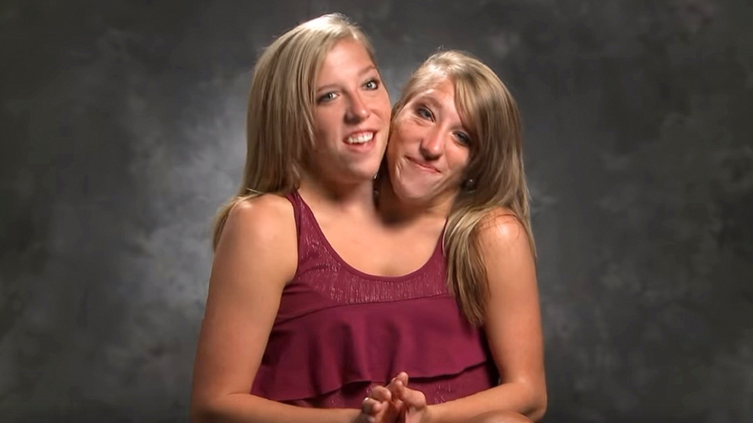 The Conjoined Twins Abby And Brittanny Frontlines Media
